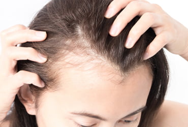 female pattern hair loss baldness visual presentation