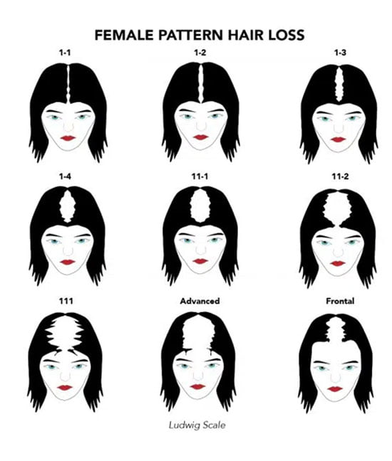 ludwig scale showing female hair loss levels also known as female pattern hair loss types