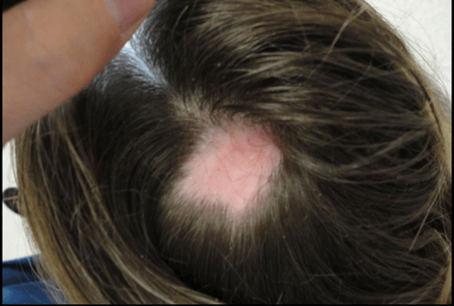 doctor examining patient with Cicatricial Alopecia
