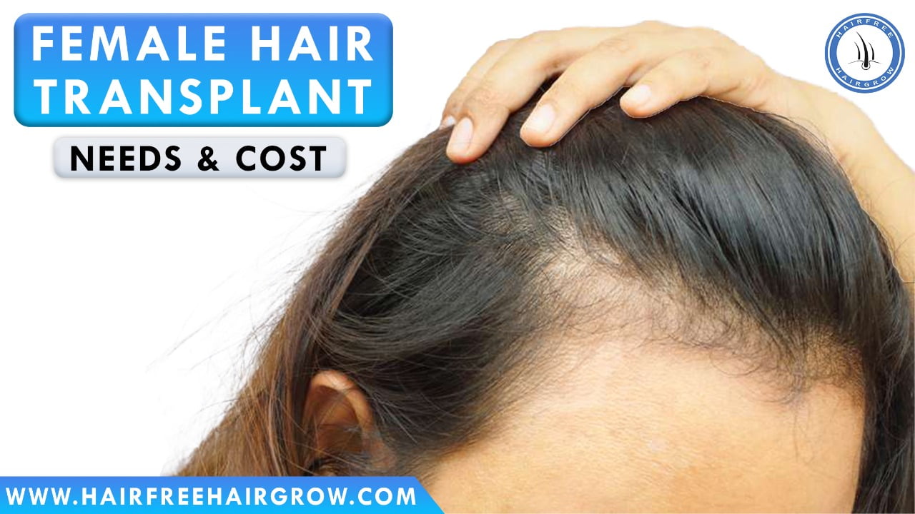 a female with hair loss at side considering female hair transplant