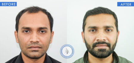 front view of before and after results of androgenetic alopecia cure treatment done at best hair transplant clinic in india hairfreehairgrow