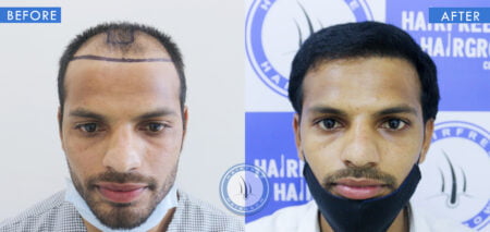 front view of before and after hair loss at 17 male treatment done at best hair transplant clinic in india hairfree and hairgrow clinic