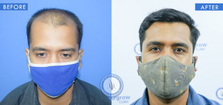 front view of before and after mens hair surgery treatment done at best hair transplant clinic in india hairfree and hairgrow clinic