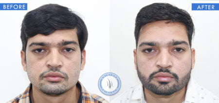 front view of before and after of best beard transplantation done at hairfree and hairgrow clinic