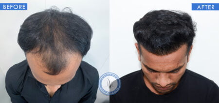 top view of before and after results of scarring hair loss treatment done at best hair transplant clinic in india hairfree and hairgrow clinic