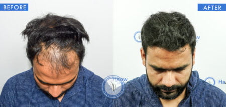 top view of before and after results of platelet rich plasma prp hair treatment done at best hair transplant clinic in india hairfree hairgrow