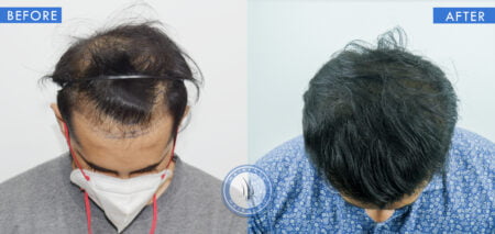 top view of before and after results of alopecia treatment done at best hair transplant clinic in india hairfree and hairgrow clinic