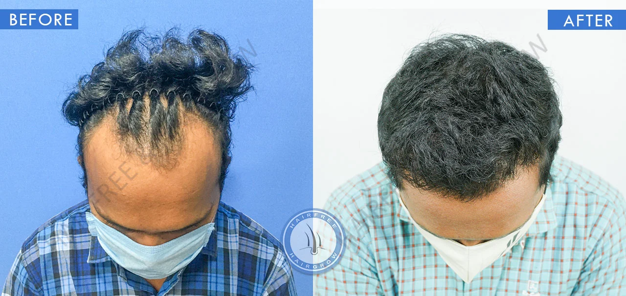 hair-transplant-before-after