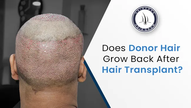 patient showing donor area used for hair transplant as a part of concern about does donor hair grow back after hair transplant