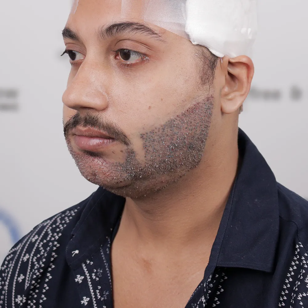 Beard Hair Transplant 