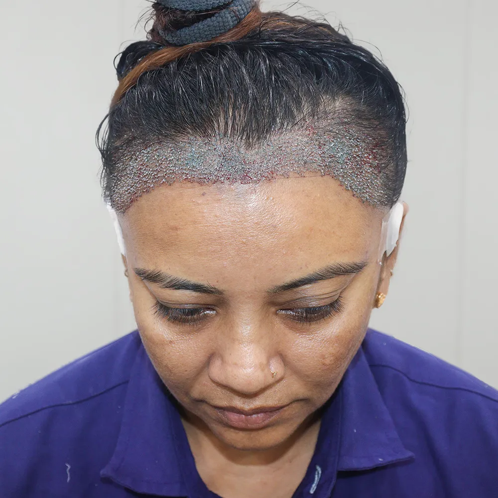 Female Hair Transplant 
