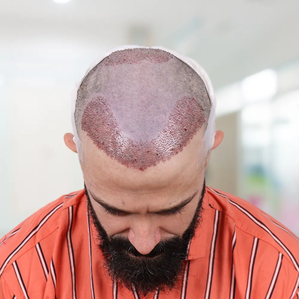 Hairline Reconstruction