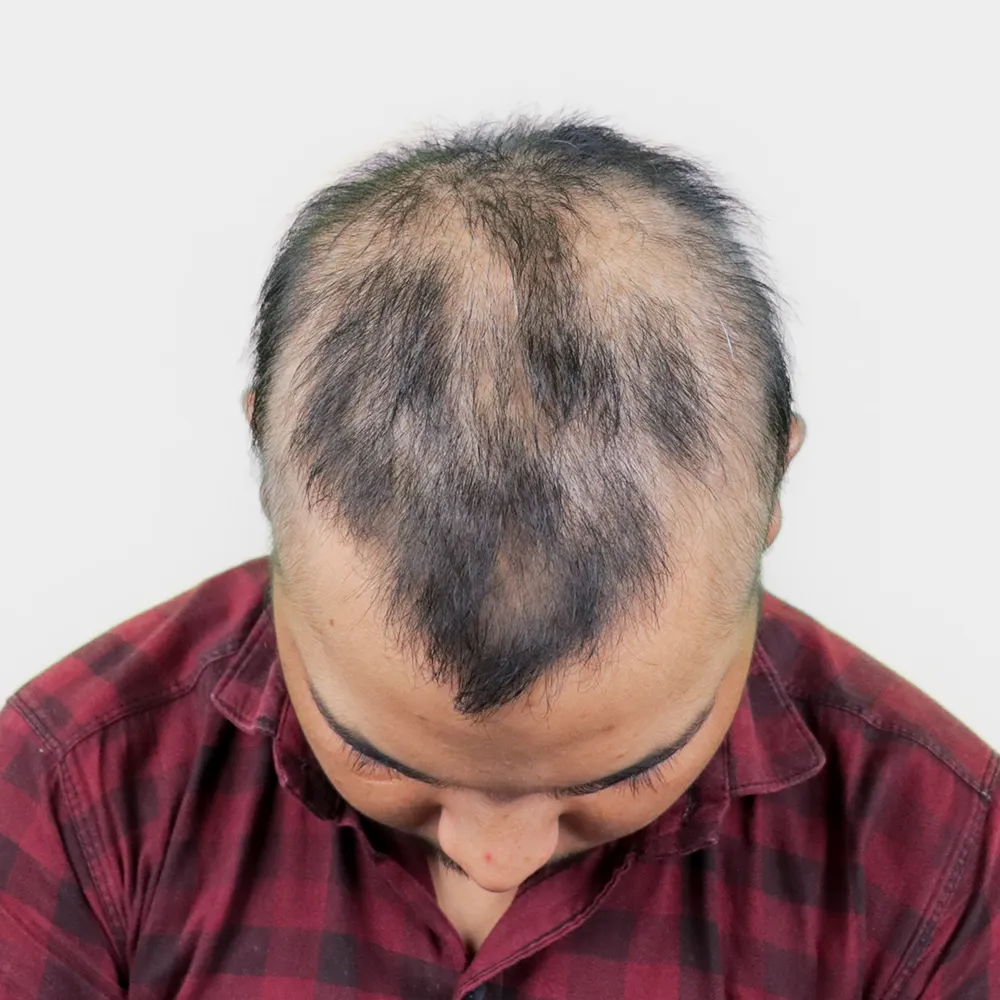 Hair Loss Treatment