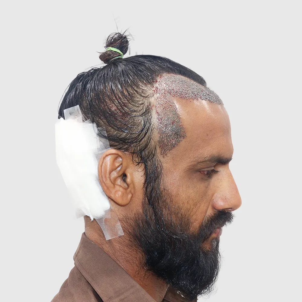 Non Shave Hair Transplant 