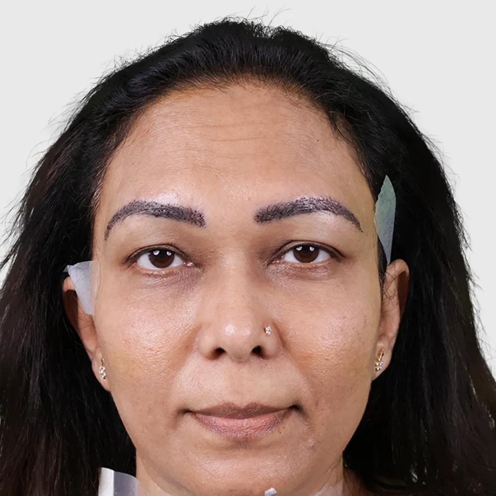 Eyebrow Hair Transplant 