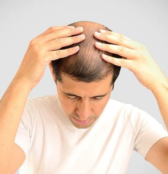 doctor showing results of hair restoration with big fue technique
